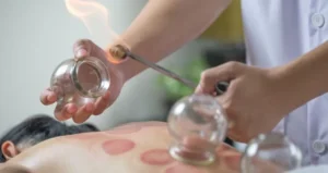 cupping