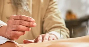 acupuncture